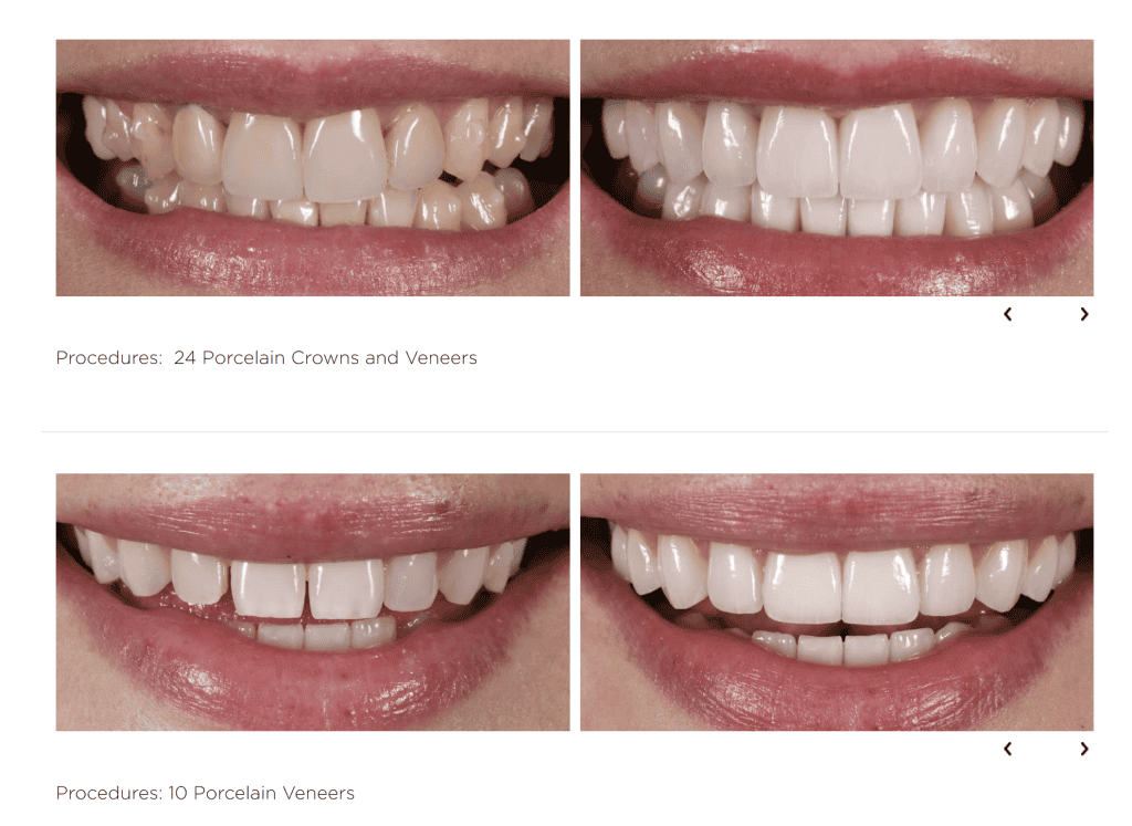 Top image: Close-up of two before-and-after photos showing teeth improved by 24 porcelain crowns and veneers, perfect for showcasing results on dental websites. Bottom image: Close-up of two before-and-after photos showing teeth improved by 10 porcelain veneers, a guide to beautiful transformations. - Clio Websites | Top Canadian Web Design Company