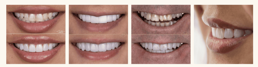 A collage of five images showcasing radiant smiles celebrates the art of dental design. Four images highlight varying shades of white teeth, some with noticeable enhancements. The fifth image features a close-up side view of a person smiling, revealing well-aligned teeth reminiscent of the best dental websites. - Clio Websites | Top Canadian Web Design Company