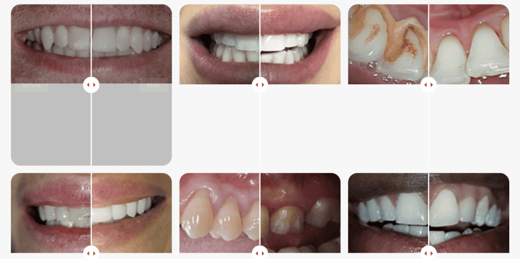 A grid of six sets of before-and-after images showcases remarkable dental transformations often featured on the best dental websites. Each pair highlights improved teeth conditions with cleaner, whiter, and straighter appearances in the after pictures compared to the before shots. - Clio Websites | Top Canadian Web Design Company